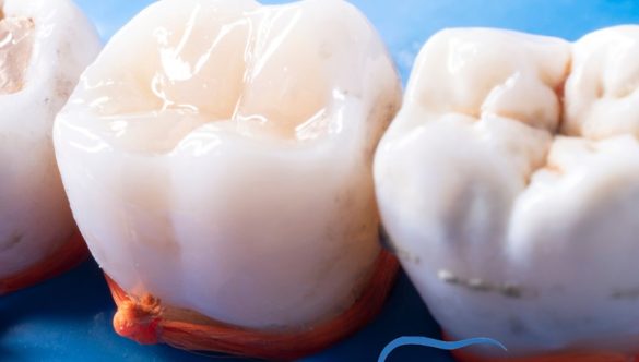 Composite ou Porcelaine : Quelle Différence ?