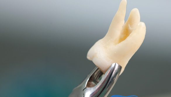 Soins Post-Opératoires Après l’Extraction de Dents