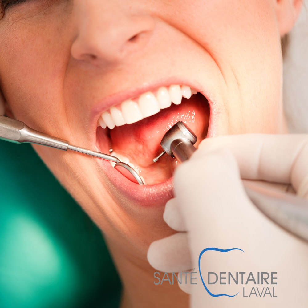 Nettoyage dentaire régulier : une étape clé pour un sourire sain