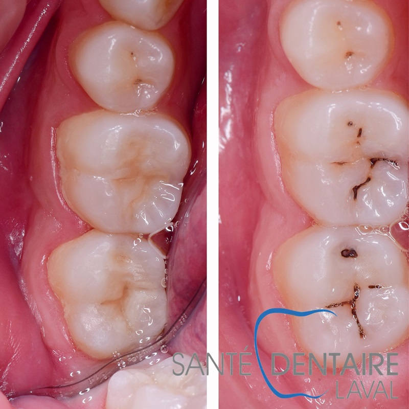 Prévention des Caries : Un Geste Essentiel