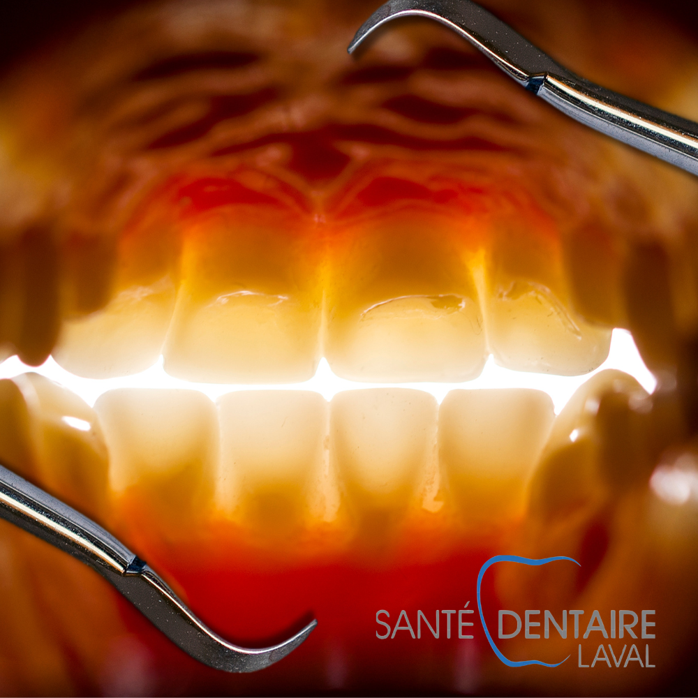 Maladie d’Alzheimer : un lien avec la santé bucco-dentaire ?
